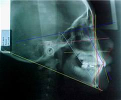 Radiografía lateral de cráneo de inicio (fig.5)
