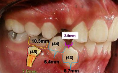 Fotografía Intraoral derecha análisis de especio diferencial disponible en hemiarcada. (fig.9)