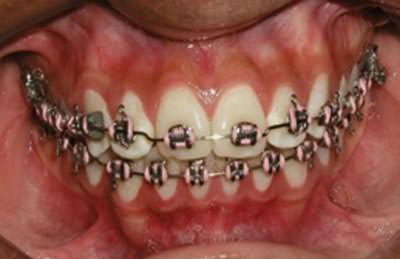Fig.14 intraoral de frente de progreso