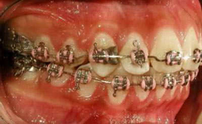 Intraoral lateral derecha de progreso (fig.15)