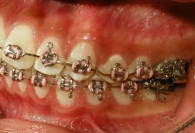 Intraoral lateral izquierda de progreso (fig.16)