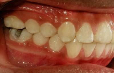Fotografía Intraoral lateral derecha final (fig. 22)