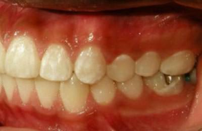 Fotografía Intraoral lateral izquierda (Fig. 23)