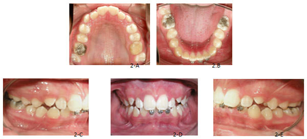 Figura 2 Fotografías intraorales, A oclusal superior, B oclusal inferior, C lateral derecha, D de frente en oclusión céntrica, E lateral izquierda.