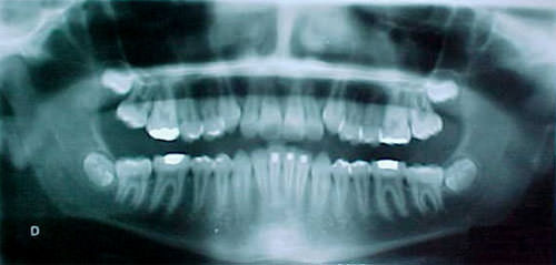 Figura 3 Radiografía panorámica inicial.