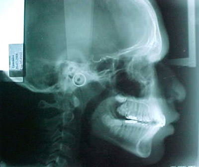Figura 4 Radiografía cefálica lateral de inicio.