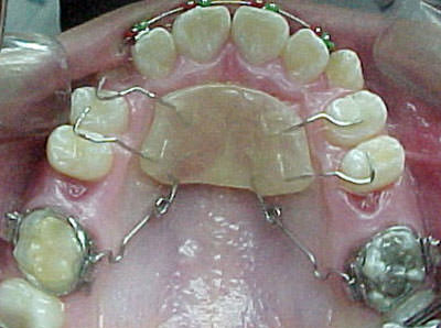 Figura 5 Fotografía intraoral oclusal superior en donde se puede observar péndulo de Hilgers luego de 7 meses de su colocación, el cual consta de un botón de acrílico central con 4 apoyos oclusales a nivel de premolares, y dos resortes de TMA (Titanio Molibdeno Alloy), los que se insertan en las cajas linguales de las bandas de los primeros molares maxilares. Se observa el espacio presente entre los segundos premolares y los primeros molares como resultado de la distalización.