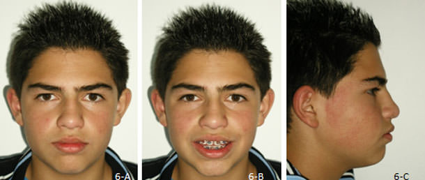 Figura 6 Fotografías extraorales control a un año de retirar el péndulo de Hilgers, y colocación del aparato de Transpalanance. 6-A frente, 6-B frente sonrisa, 6-C perfil.
