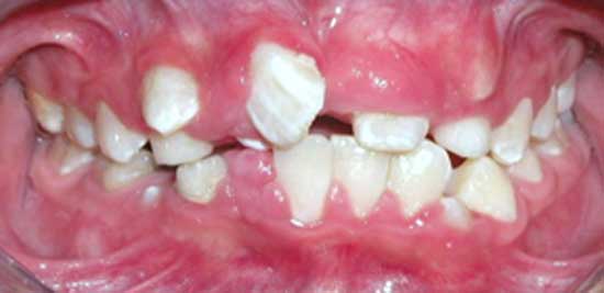 Fig 3 Fotografía intraoral inicio del tratamiento