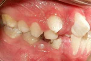 Fig 4 Fotografía intraoral derecha