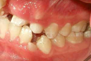 Fig 5 Fotografía intraoral izquierda