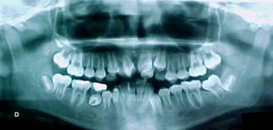 Fig 6 Radiografía panorámica inicio del tratamiento