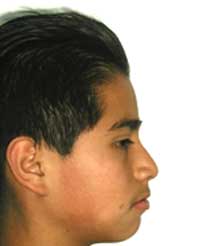 Fig 10 B Fotografía de perfil. Progreso