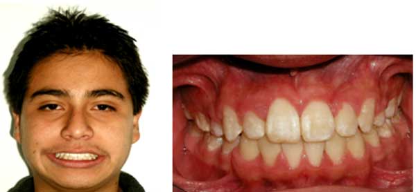 Fig 14 Fotografía de frente. Correcta alineación y overjet y overbite