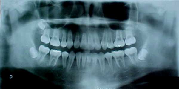 Fig 15 Radiografía panorámica final