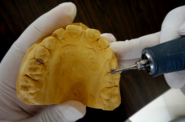 Figure 2 Notches made at the junction of the marginal ridges of deciduous molars.