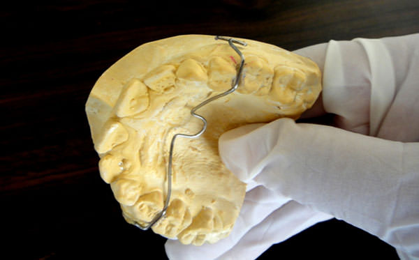 Figure 3 TPA adapted across the palate and passing through the Notches made at the junction of the marginal ridges of deciduous molar