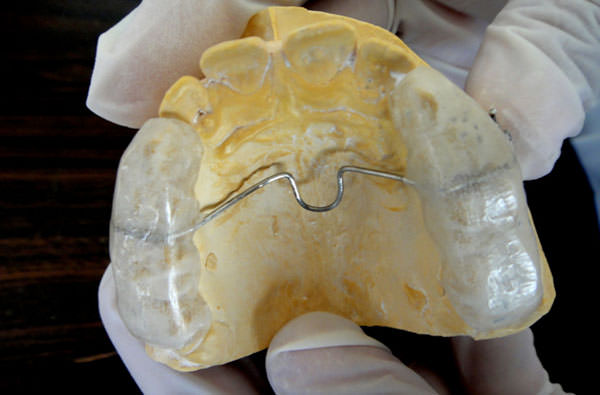 Figure 5 Acrylized appliance with TPA and acrylic bite blocks