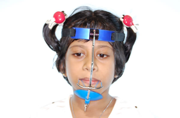 Figure 8 Orthopaedic elastic engaged from protraction hooks to the Face Mask.