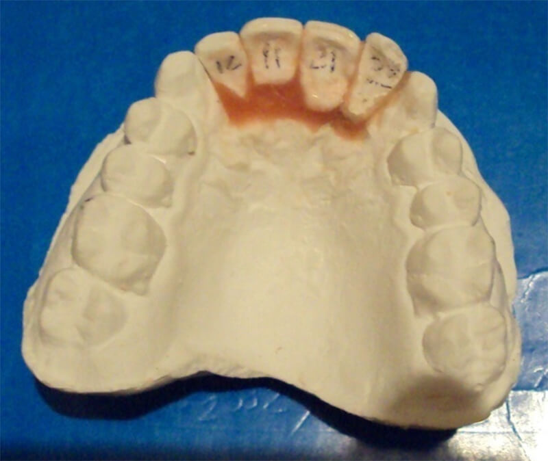 Fig 6 Modelo superior set up