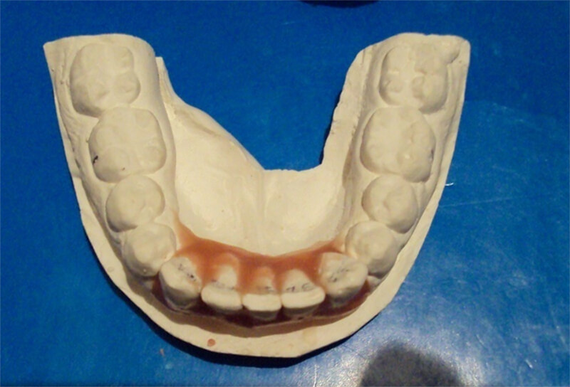 Fig 7 Modelo inferior set up