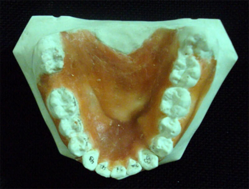 Fig 7 Modelo inferior set up