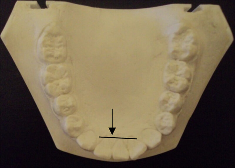 Fig 4 Modelo inferior con agenesia