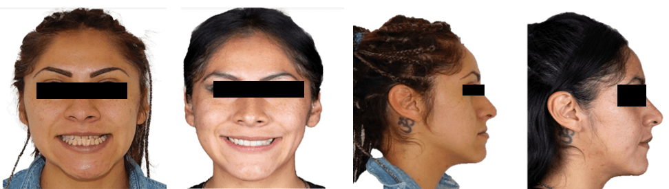 Fig. 6 comparación de inicio y final, frente y perfil.