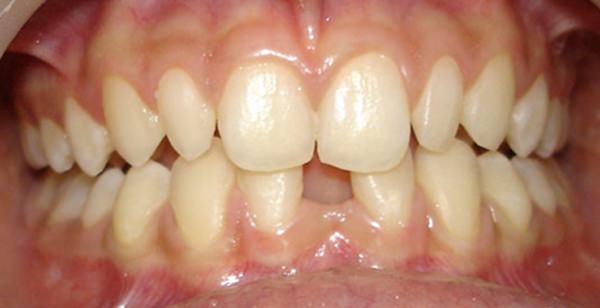 Fig.1 Pre-treatment Intraoral - frontal view