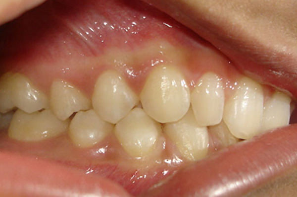 Fig.5 Pre-treatment Intraoral - right side view