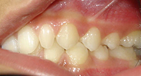 Fig.6 Pre-treatment Intraoral - left side view