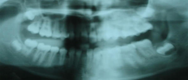Fig.8 Pre treatment O.P.G