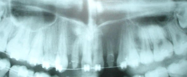 Fig 10 OPG showing space gained in the maxillary arch after placement of open coil springs 