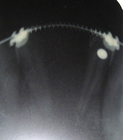 Fig. 11 IOPA showing an open coil spring placed in the Mandibular between the lateral incisors