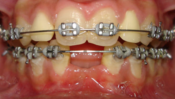 Fig 12 The Crowns have been placed on the peg laterals and sufficient space gained in the Mandibular anterior for placement of Implant.