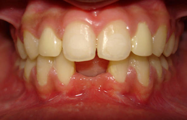 Fig 13 Intra oral frontal View after orthodontic treatment