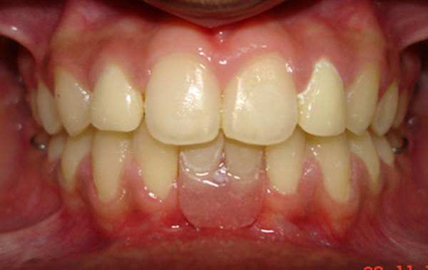 Fig.14 Intra oral Frontal view after placement of removable prosthesis