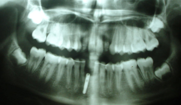 Fig . 15 OPG showing the implant placed in the Mandibular incisal region