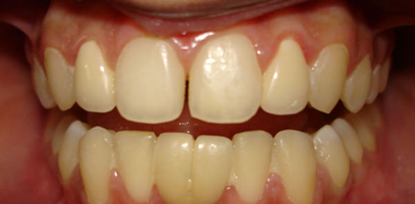 Fig 15 Intra oral frontal- Post Implant placement