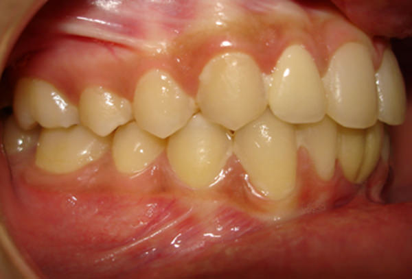 Fig. 17 Post treatment intraoral Right Side View