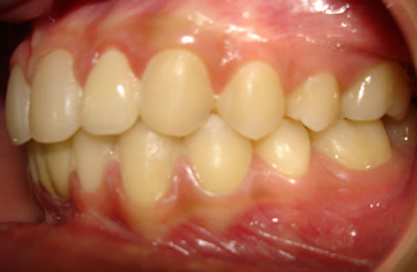 Fig. 18 Post treatment intraoral Left Side View