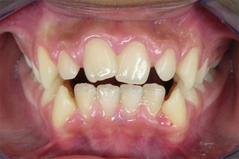 Fig. 1 Mordida abierta anterior. Postgrado de Ortodoncia de la Facultad de Odontología UCV. (2009)