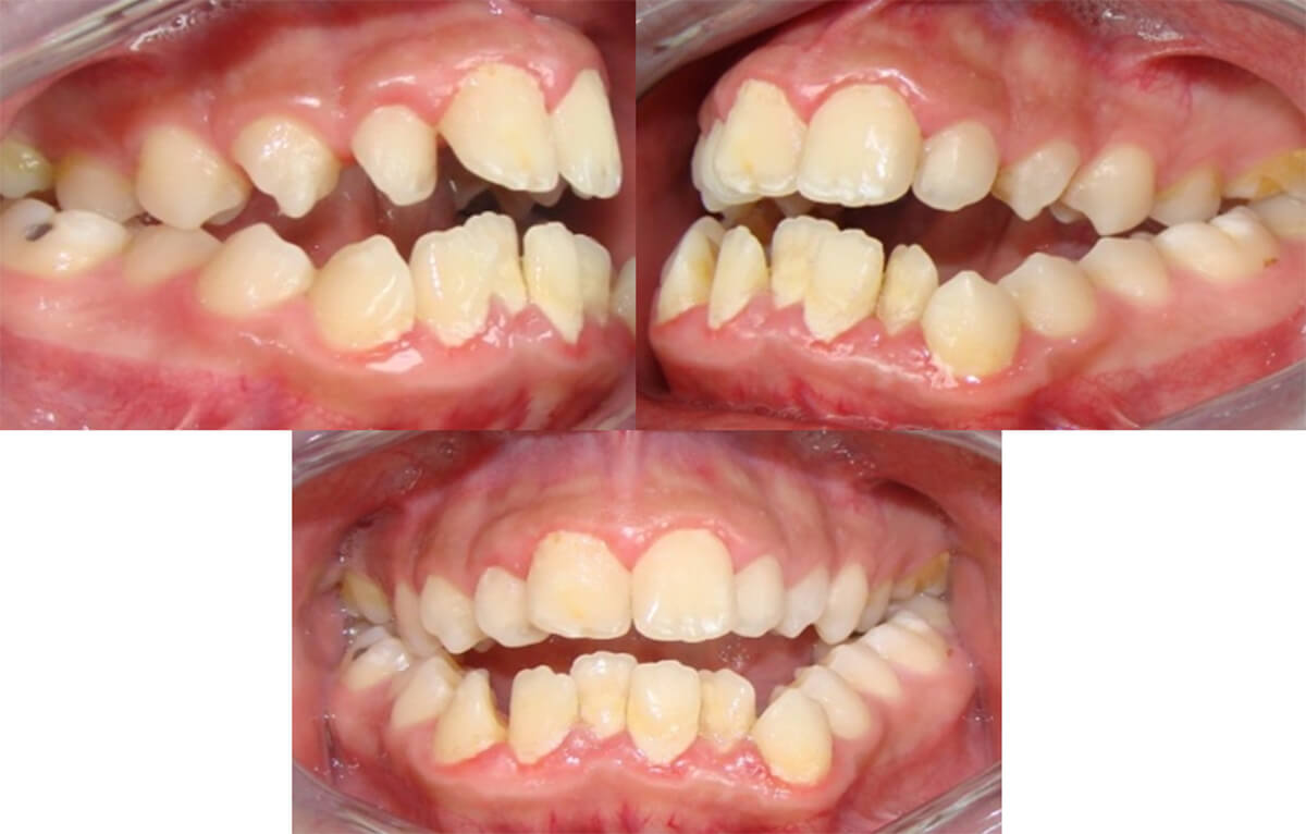Fig. 3 Mordida abierta completa. Cortesía de la Od. Sorelis Durand. Postgrado de Ortodoncia de la Facultad de Odontología UCV (2009).