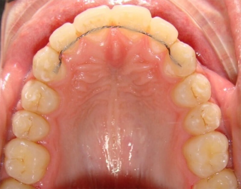 FIG.22 Retenedor 3x3. Tomado del registro de pacientes del postgrado de Ortodoncia de la Facultad de Odontología UCV (2009).