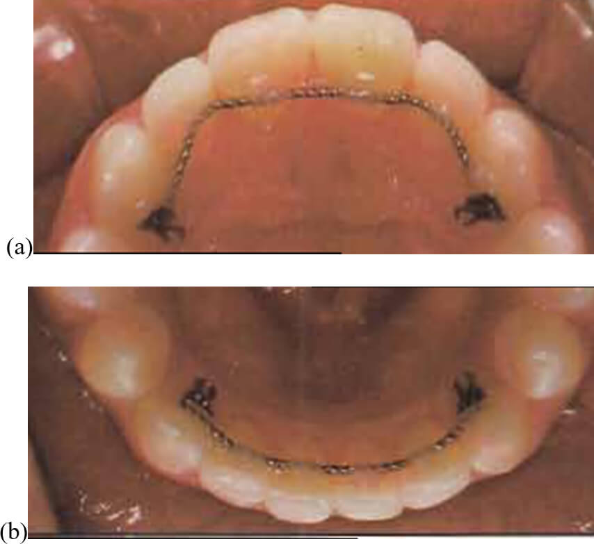Fig.23 Retenedor de fuerza amplificada. (a) maxilar superior, (b) maxilar inferior.Tomado de Sheridan y cols., 1997.88