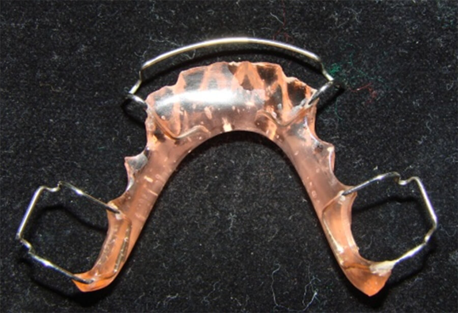 Fig. 24 Hawley con ganchos Adams. Postgrado de ortodoncia de la Facultad de Odontología UCV (2009).