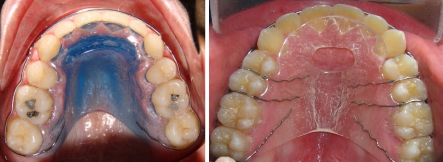 Fig. 25 Retenedor circunferencial, con recordatorio para la lengua. Cortesía Od. Angélica Herrera. Postgrado de Ortodoncia de la Facultad de Odontología UCV, 2009.