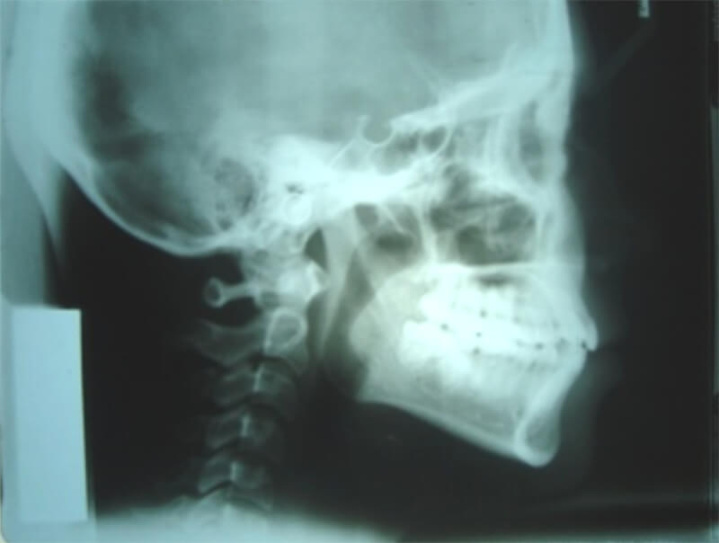 Fig. 4 Rx lateral de cráneo inicial