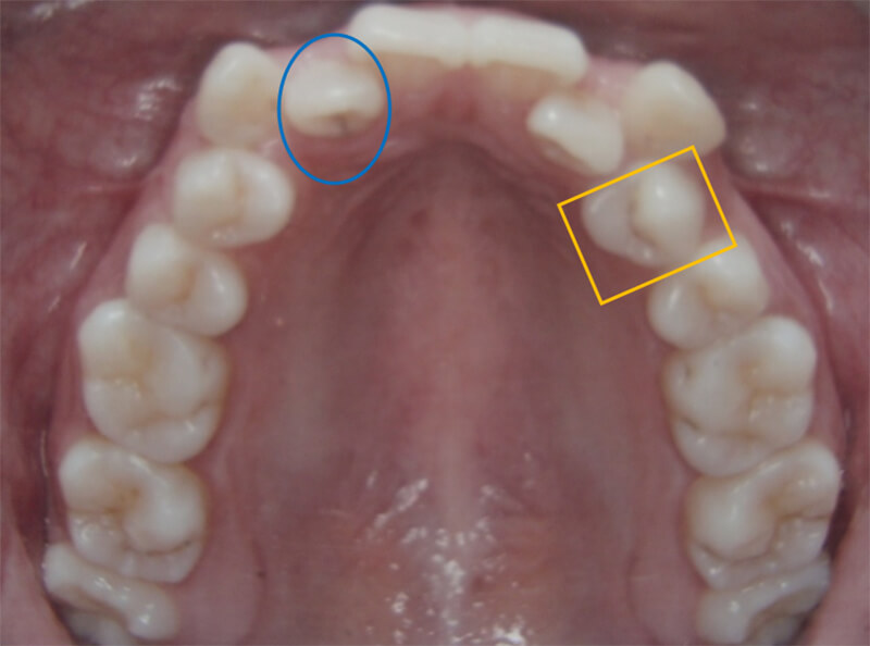 Fig 8 Fotografía oclusal superior inicio