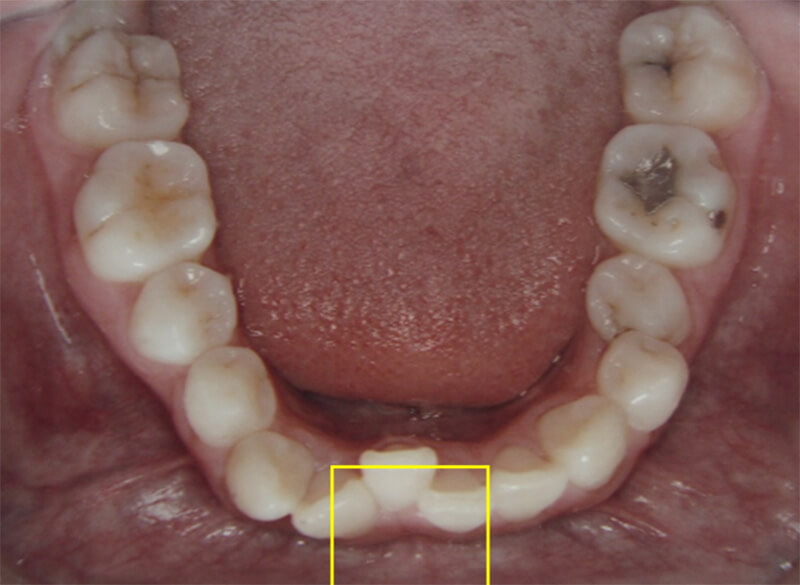 Fig 9 Fotografía oclusal inferior inicio